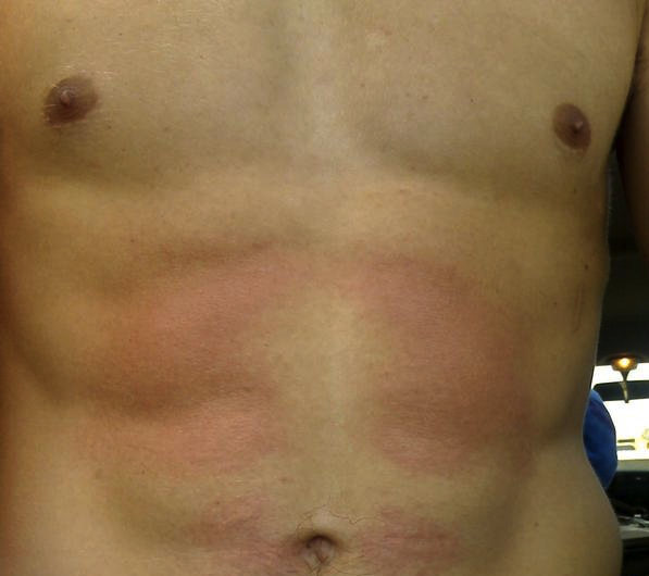 How to Beat Board Rash...With Science...